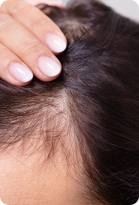 Chute de cheveux avant